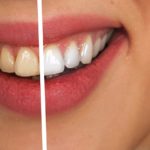 Everything You Need To Know About sparkling white Teeth