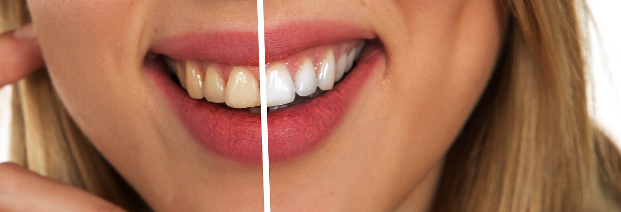 Everything You Need To Know About sparkling white Teeth