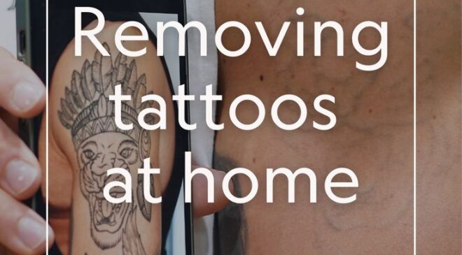 What tattoos cannot be removed