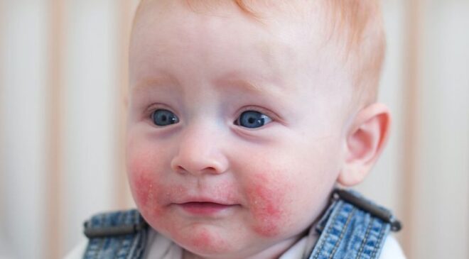 Why do white spots appear on children's skin