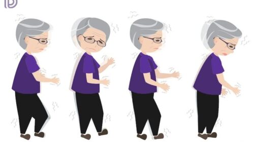 HIFU, a solution to movement disorders